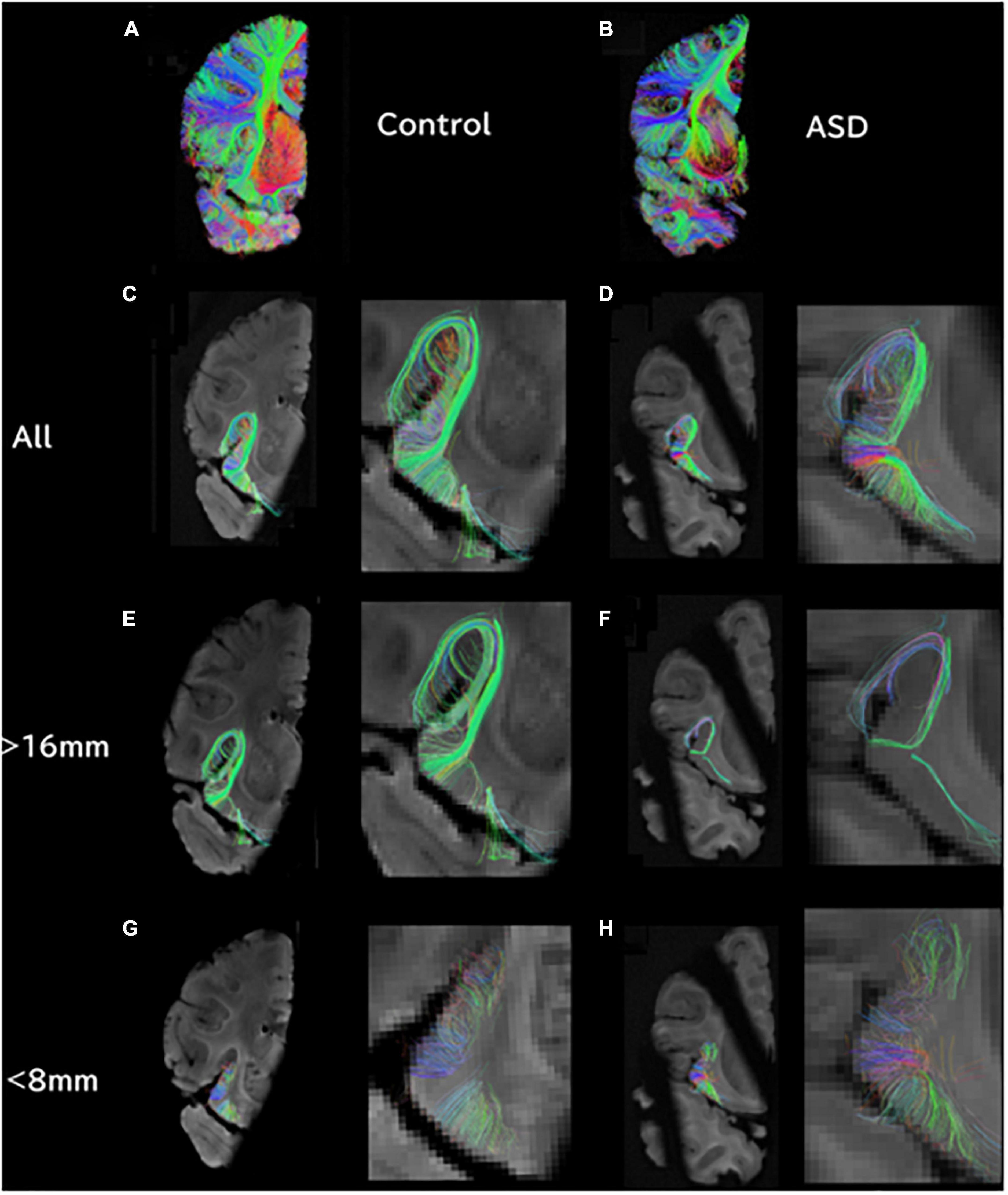 Integration of structural MRI and epigenetic analyses hint at linked cellular defects of the subventricular zone and insular cortex in autism: Findings from a case study